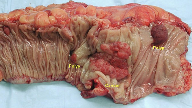 Colon specimen cross section showing cancer, and polyps